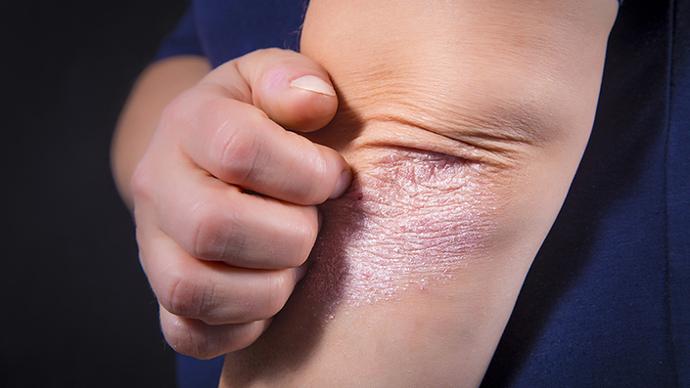 Le psoriasis